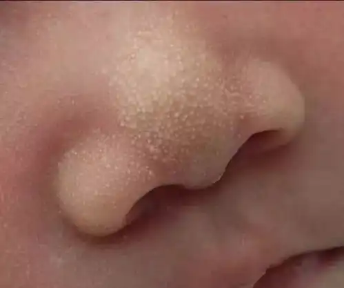 新生儿鼻尖上的小白点,真是因为孕期盐吃多了妈妈别急着处理