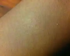 皮肤出现一块小小的白点不知道是什么不痛不痒
