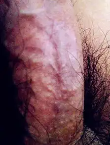 阴茎皮肤下长了一片白点,如图,小米粒大小,不痛不痒,请问是什么病怎么用药