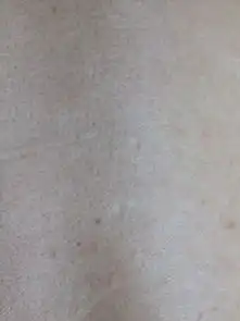 皮肤上的小白点是什么