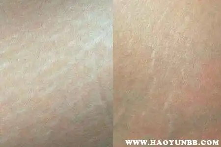胖子肚子上的肥胖纹