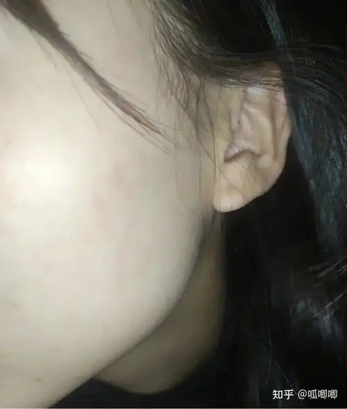 有哪些去黑色痘印的护肤品