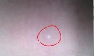 皮肤长了白点会是什么病