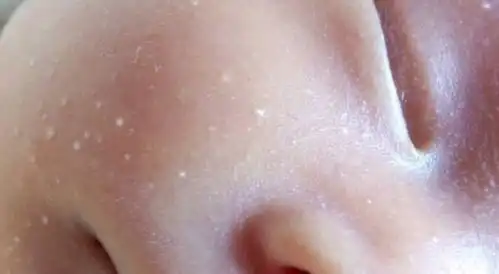 婴儿脸上一粒粒小白点,爸妈真想挤掉,错这才是正确的处理方式