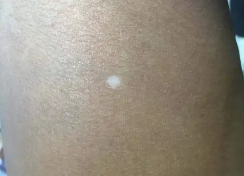 身上这些小白点可不是白癜风,可能是皮肤衰老表现